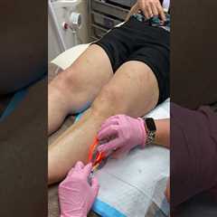Success Rate of Foam Sclerotherapy for Treating Vein Diseases in St. Louis, Missouri