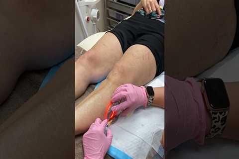Treating Varicose Veins in St. Louis, Missouri: What You Need to Know