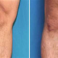 Insurance Coverage for Vein Disease Treatments in St. Louis, Missouri