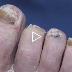 Warts, wounds and toenails with Dr Nail Nipper