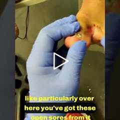 Understanding Athlete's Foot and Its Impact 🏃‍♂️🦵
