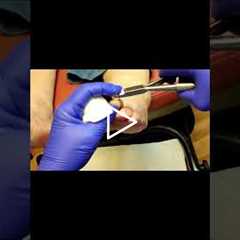 Dealing with Gout A Finger Issue  #GoutAwareness #HealthTips #UnexpectedSymptoms