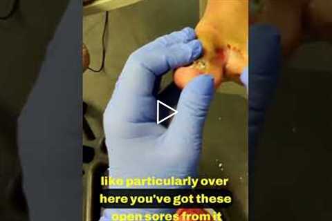 Understanding Athlete's Foot and Its Impact 🏃‍♂️🦵