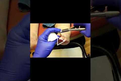 Dealing with Gout A Finger Issue  #GoutAwareness #HealthTips #UnexpectedSymptoms