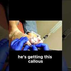 How Toe Deformities Cause Calluses and What You Can Do About It #ToeDeformity #FootPainSolutions