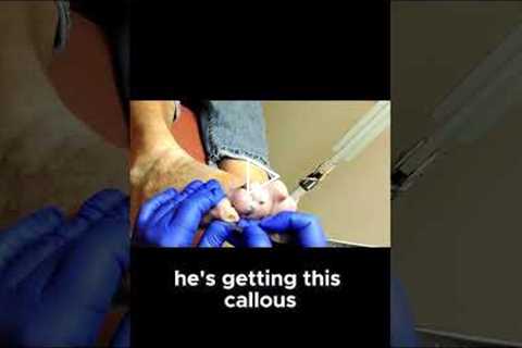How Toe Deformities Cause Calluses and What You Can Do About It #ToeDeformity #FootPainSolutions