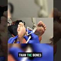 Understanding Pressure Problems on Skin | Why Calluses Form