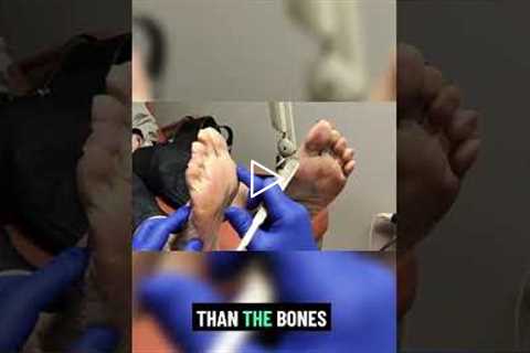 Understanding Pressure Problems on Skin | Why Calluses Form