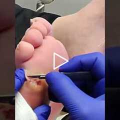 Understanding the Cause of a Foot Wound 👣