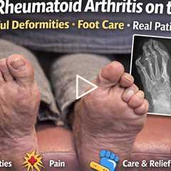 Severe Rheumatoid Arthritis on the Feet | Painful Deformities, Foot Care & Real Patient Story