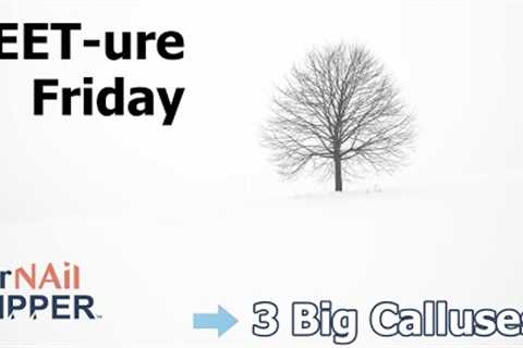 FEET-ure Friday | 3 Big Calluses  🦶✨