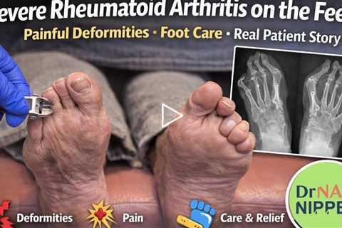 Severe Rheumatoid Arthritis on the Feet | Painful Deformities, Foot Care & Real Patient Story