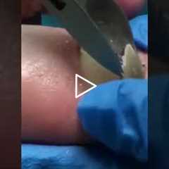 Dog Hair Under a Toenail?! The Real Story Behind This Nail – Halftime