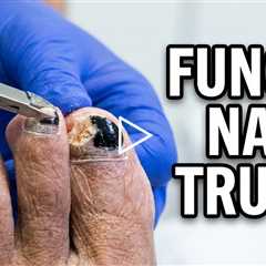 Does Nail Polish Hide Toenail Fungus? The Truth About Fungal Nails & Treatment Options