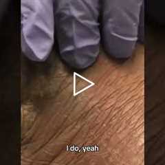 You’ve Got Athlete’s Foot — Here’s What We Do