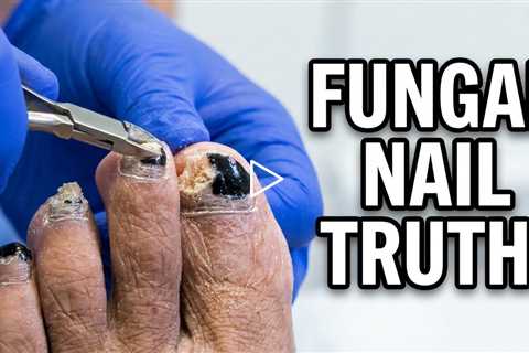 Does Nail Polish Hide Toenail Fungus? The Truth About Fungal Nails & Treatment Options