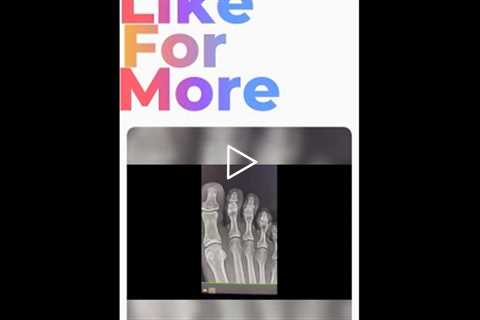 Understanding X-Rays: Decoding the Foot Condition