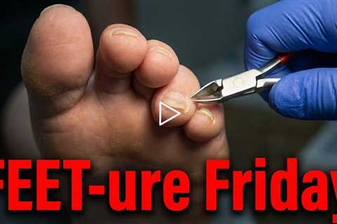FEET-ure Friday | Loose Toenail? Safe Trim + Important Skin Check Reminder