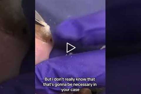 Thick Toenails: Treat, Remove, or Just Maintain?