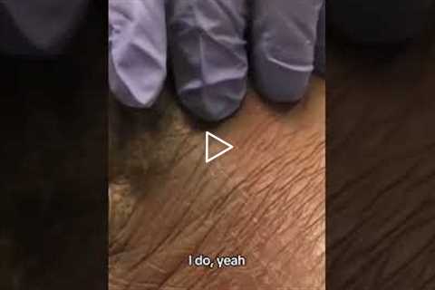 You’ve Got Athlete’s Foot — Here’s What We Do