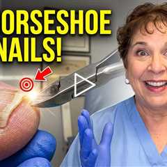 Why Some Toenails Grow Into an “Upside-Down Horseshoe” Shape 👣