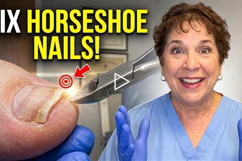 Why Some Toenails Grow Into an “Upside-Down Horseshoe” Shape 👣