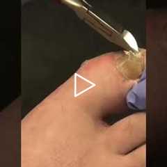 Squeaky Clippers Only 😳🔊 | Oddly Satisfying Podiatry