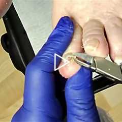 FEET-ure Friday Short video - Two Patients and One Jump Scare