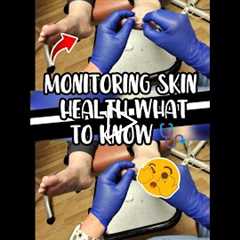 This Foot Mole Could Be Melanoma and You Won't Notice #skincancer #melanoma