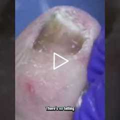 The Miracle Patient Warts Vanish Without a Trace