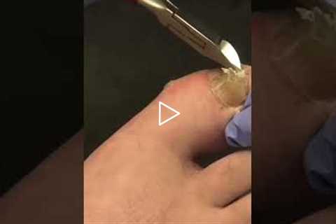Squeaky Clippers Only 😳🔊 | Oddly Satisfying Podiatry