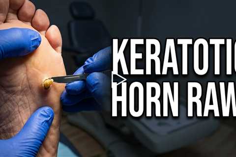 Keratic Horn Removal – Why This Callus Hurts So Much