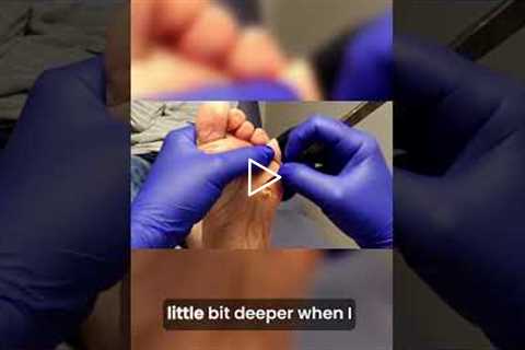Follow-Up Care for Foot Comfort | I Had to STOP… This Callus Was Too Painful 😳