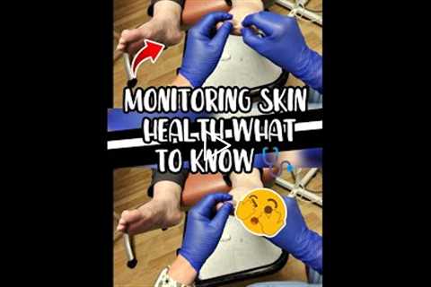 This Foot Mole Could Be Melanoma and You Won't Notice #skincancer #melanoma