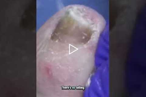 The Miracle Patient Warts Vanish Without a Trace