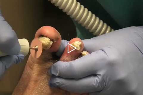 At 85, He Couldn’t Wear Shoes Without Pain