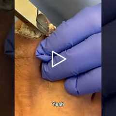 Big Callus Removal Satisfaction 👣 Huge Chunk Comes Off!