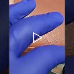 Ganglion Cyst Drainage: Watch the Fluid Come Out! 😲 | Dr Nail Nipper
