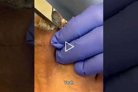 Big Callus Removal Satisfaction 👣 Huge Chunk Comes Off!