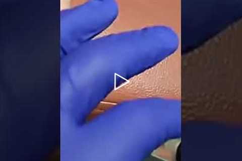 Ganglion Cyst Drainage: Watch the Fluid Come Out! 😲 | Dr Nail Nipper