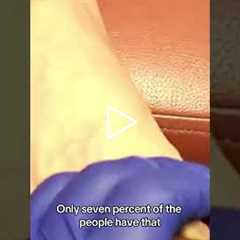 The Stroke That Leaves You Awake But Unable to Move