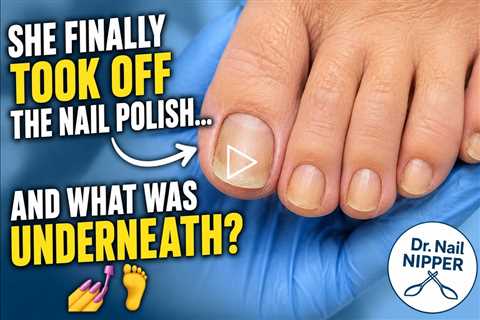 She Finally Took Off the Nail Polish... And What Was Underneath? 💅🦶