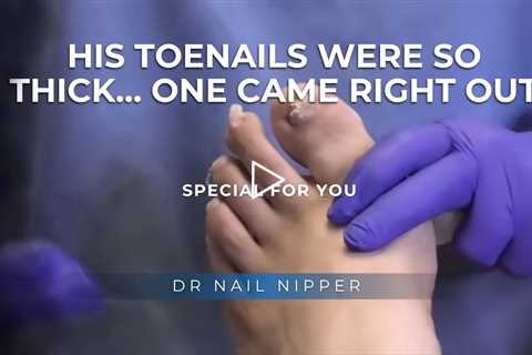 His Toenails Were So Thick… One Came Right Out 😳🦶