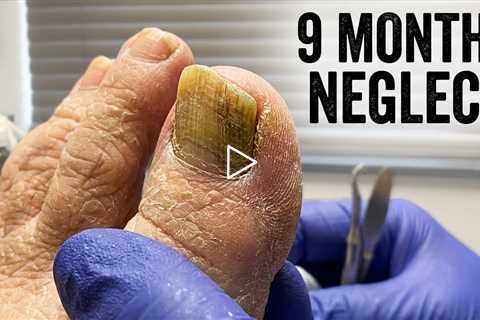 She Waited 9 MONTHS... Look at These Overgrown Toenails! 😲👣
